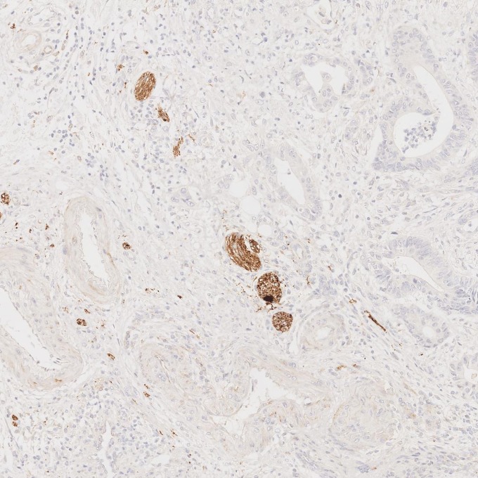 IHC staining of human colorectal cancer using 67864-1-Ig