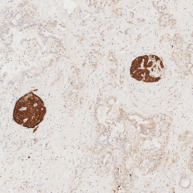 IHC staining of human pancreas cancer using 67864-1-Ig