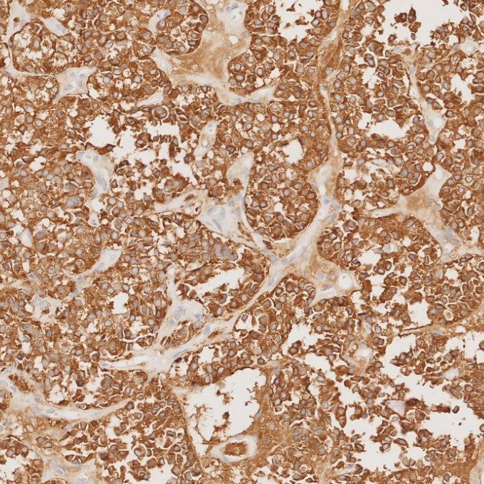 IHC staining of human pituitary adenoma using 67864-1-Ig
