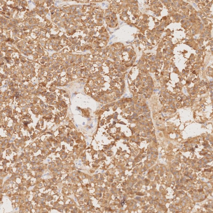 IHC staining of human pituitary adenoma using 67864-1-Ig