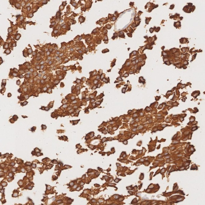 IHC staining of human pituitary adenoma using 67864-1-Ig