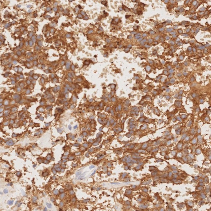 IHC staining of human pituitary adenoma using 67864-1-Ig