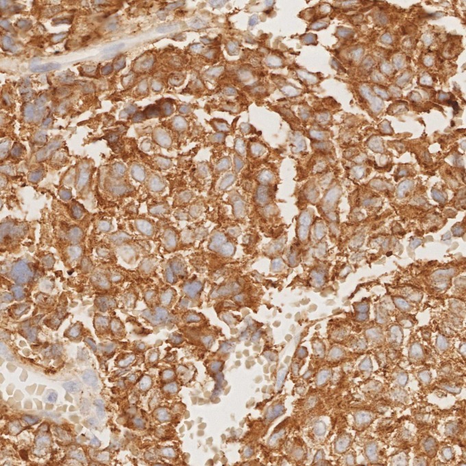 IHC staining of human pituitary adenoma using 67864-1-Ig