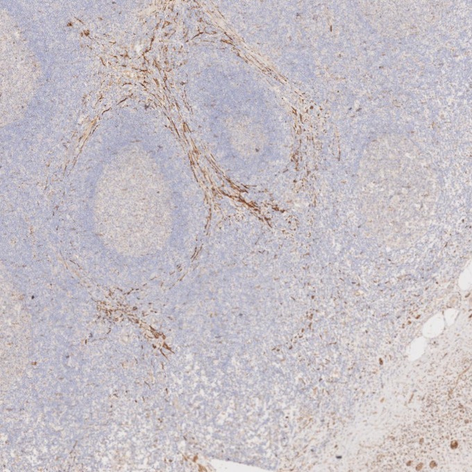 IHC staining of human appendicitis using 67864-1-Ig