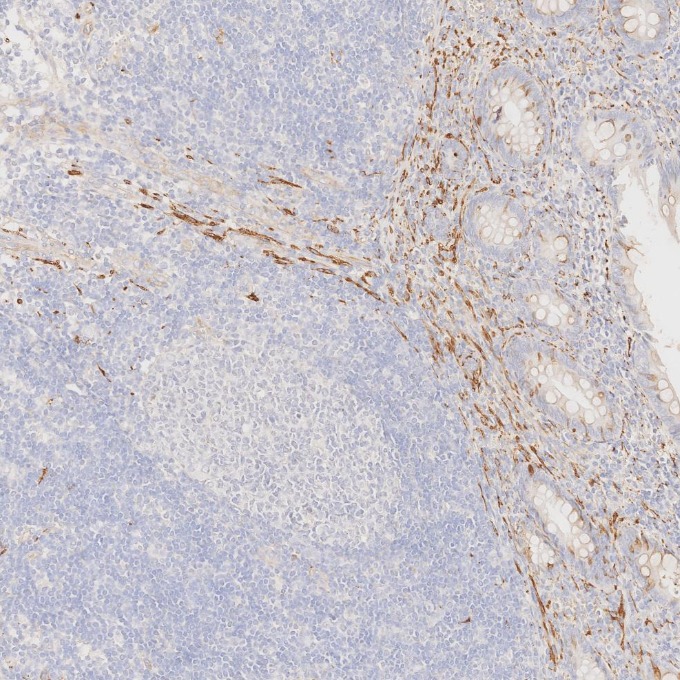 IHC staining of human appendicitis using 67864-1-Ig