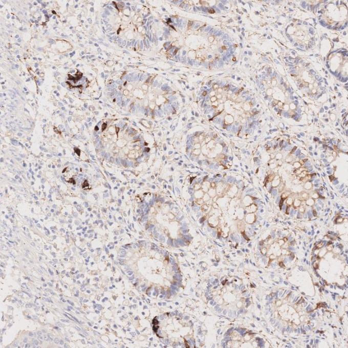 IHC staining of human colorectal cancer using 67864-1-Ig