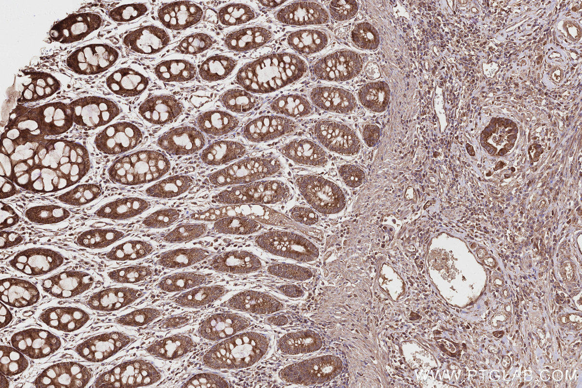 IHC staining of human rectal cancer using 27749-1-AP IHC staining of human rectal cancer using 27749-1-AP