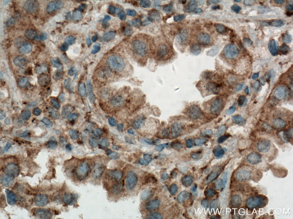 IHC staining of human lung cancer using 66775-1-Ig