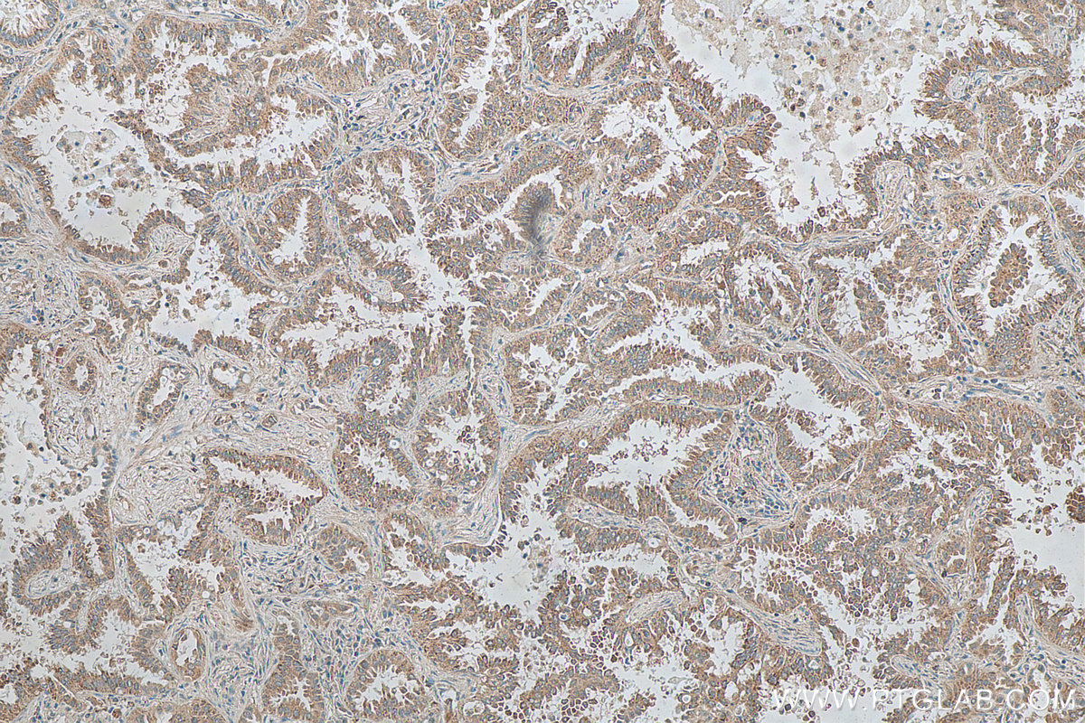IHC staining of human lung cancer using 67020-1-Ig
