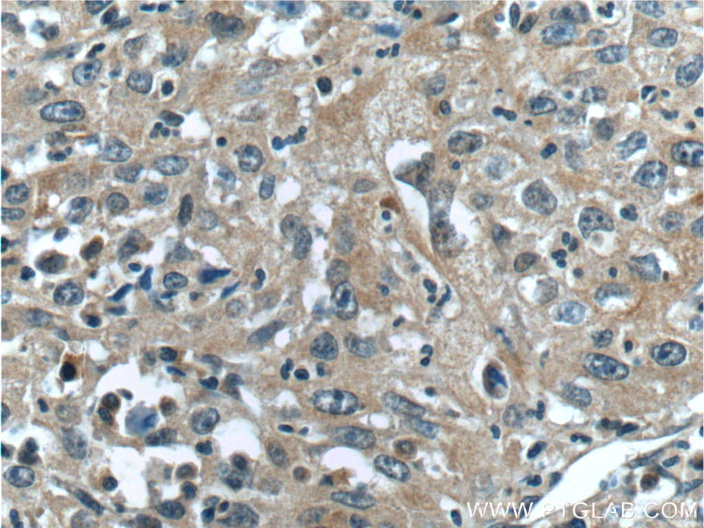 IHC staining of human cervical cancer using 25697-1-AP