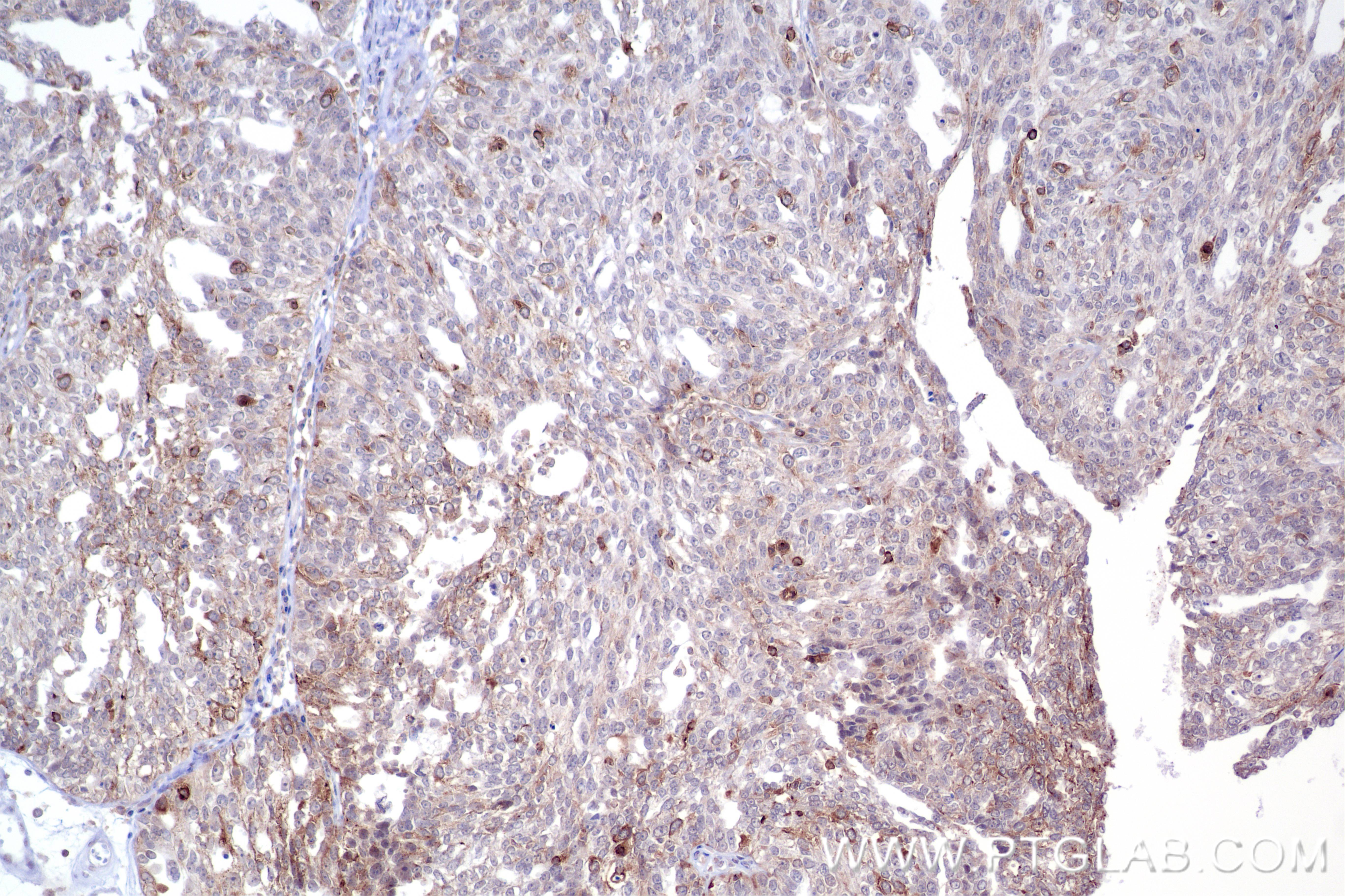 IHC staining of human ovary cancer using 84940-5-RR