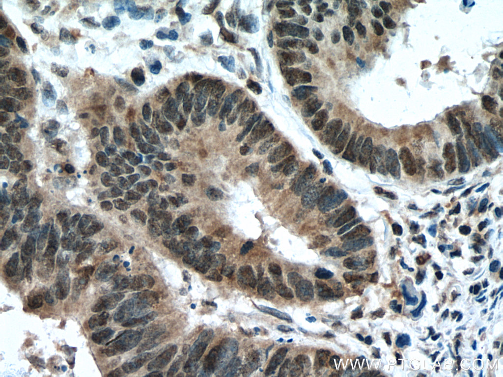 IHC staining of human colon cancer using 16114-1-AP