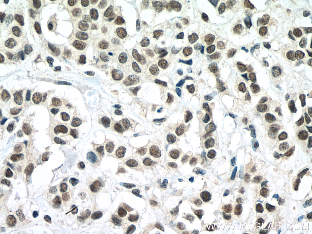 IHC staining of human breast cancer using 67569-1-Ig (same clone as 67569-1-PBS)