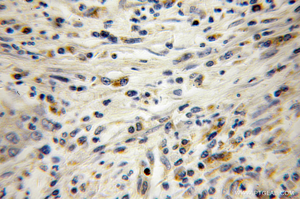 IHC staining of human colon cancer using 10234-2-AP