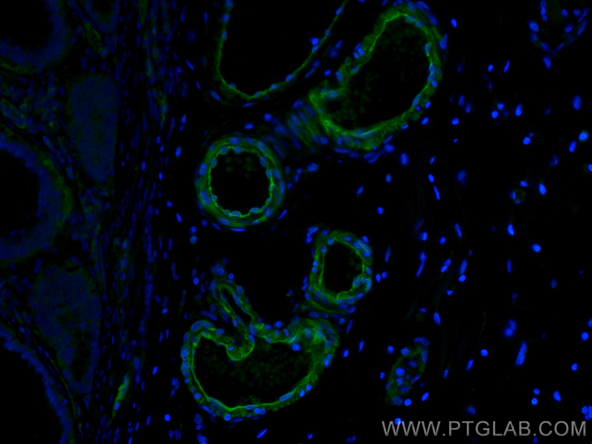 IF Staining of human colon cancer using 60044-1-Ig