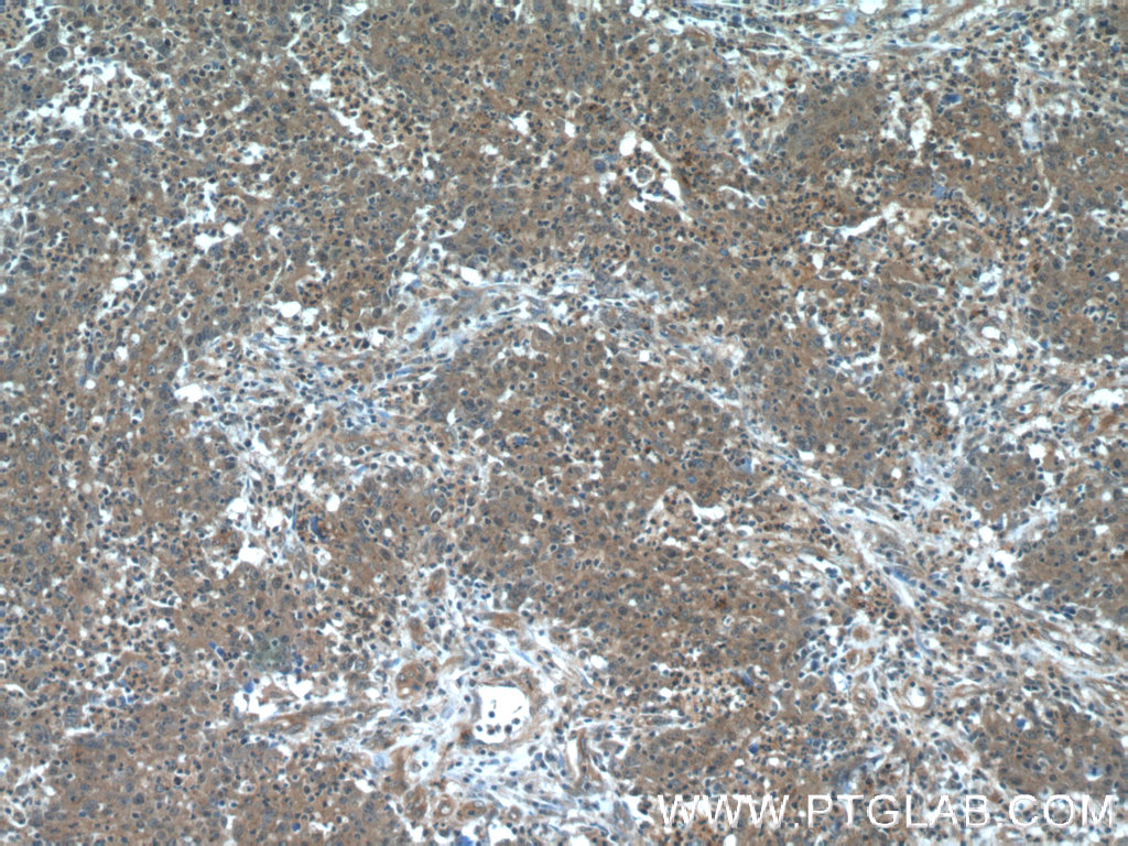 IHC staining of human colon cancer using 60044-1-Ig