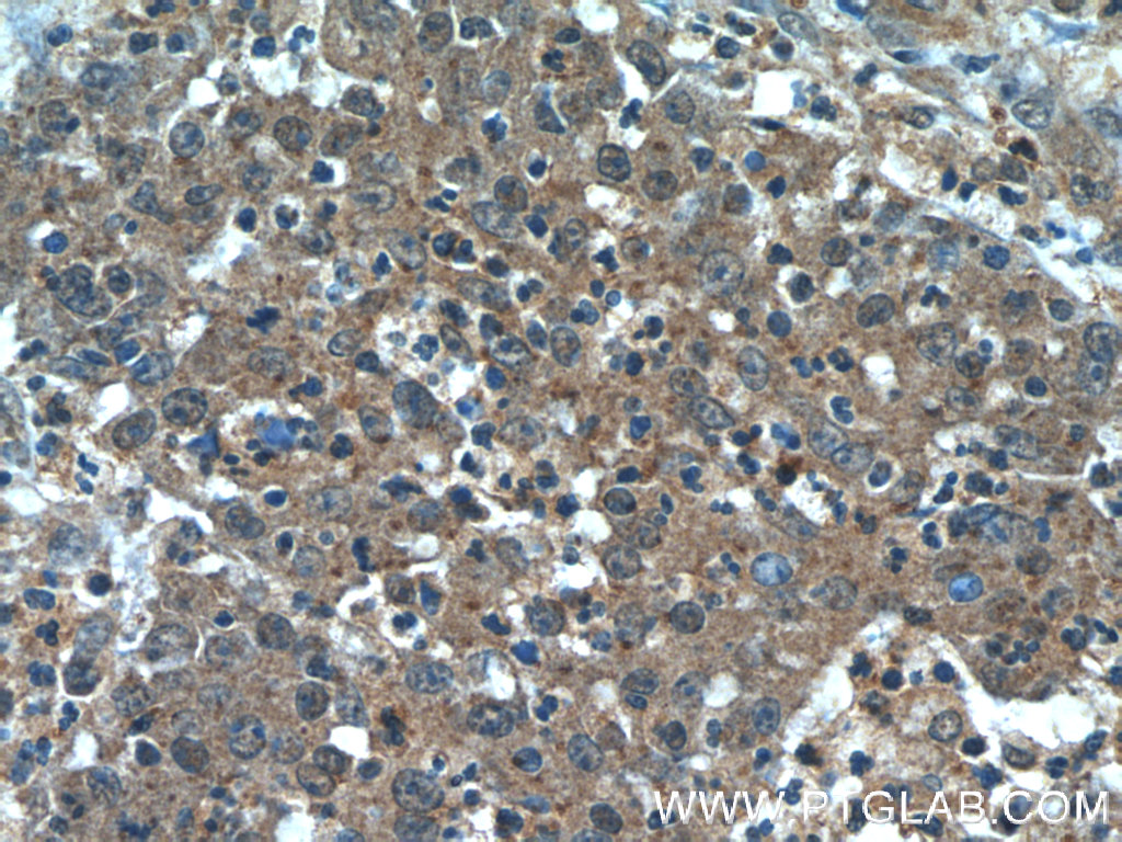 IHC staining of human colon cancer using 60044-1-Ig