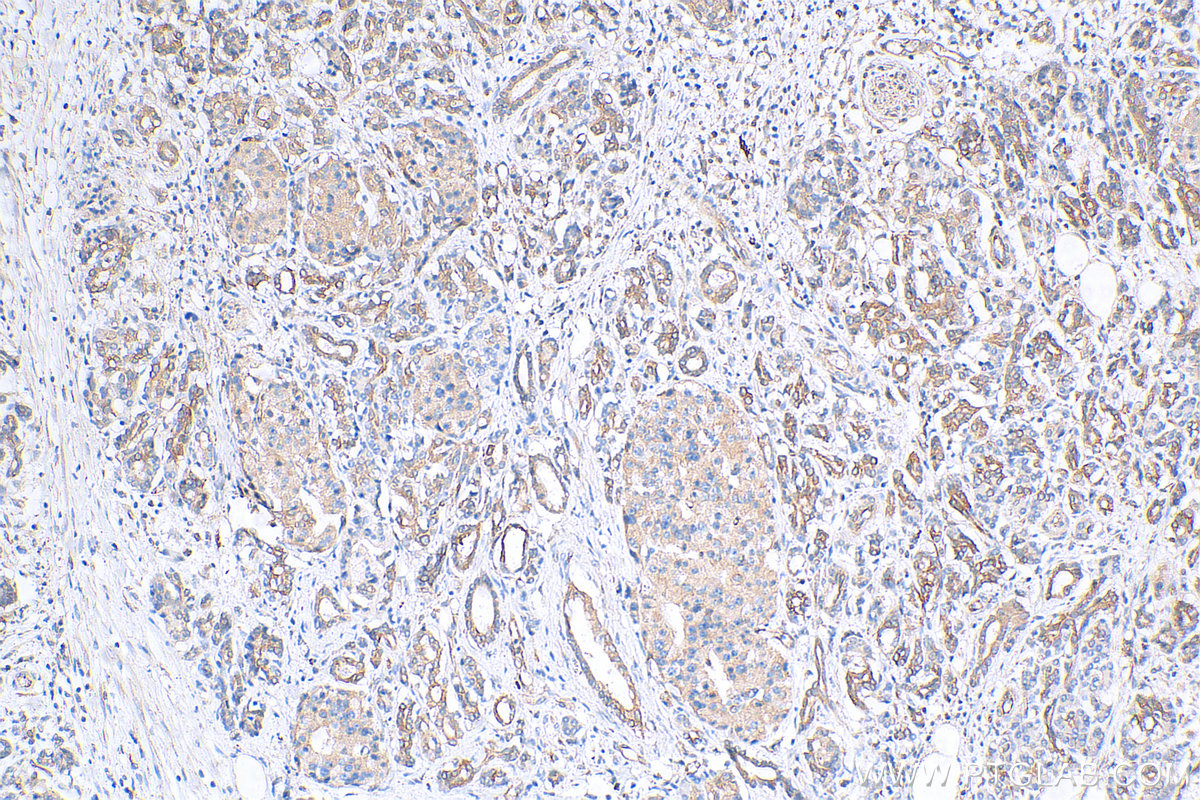 IHC staining of human pancreas cancer using 68412-1-Ig