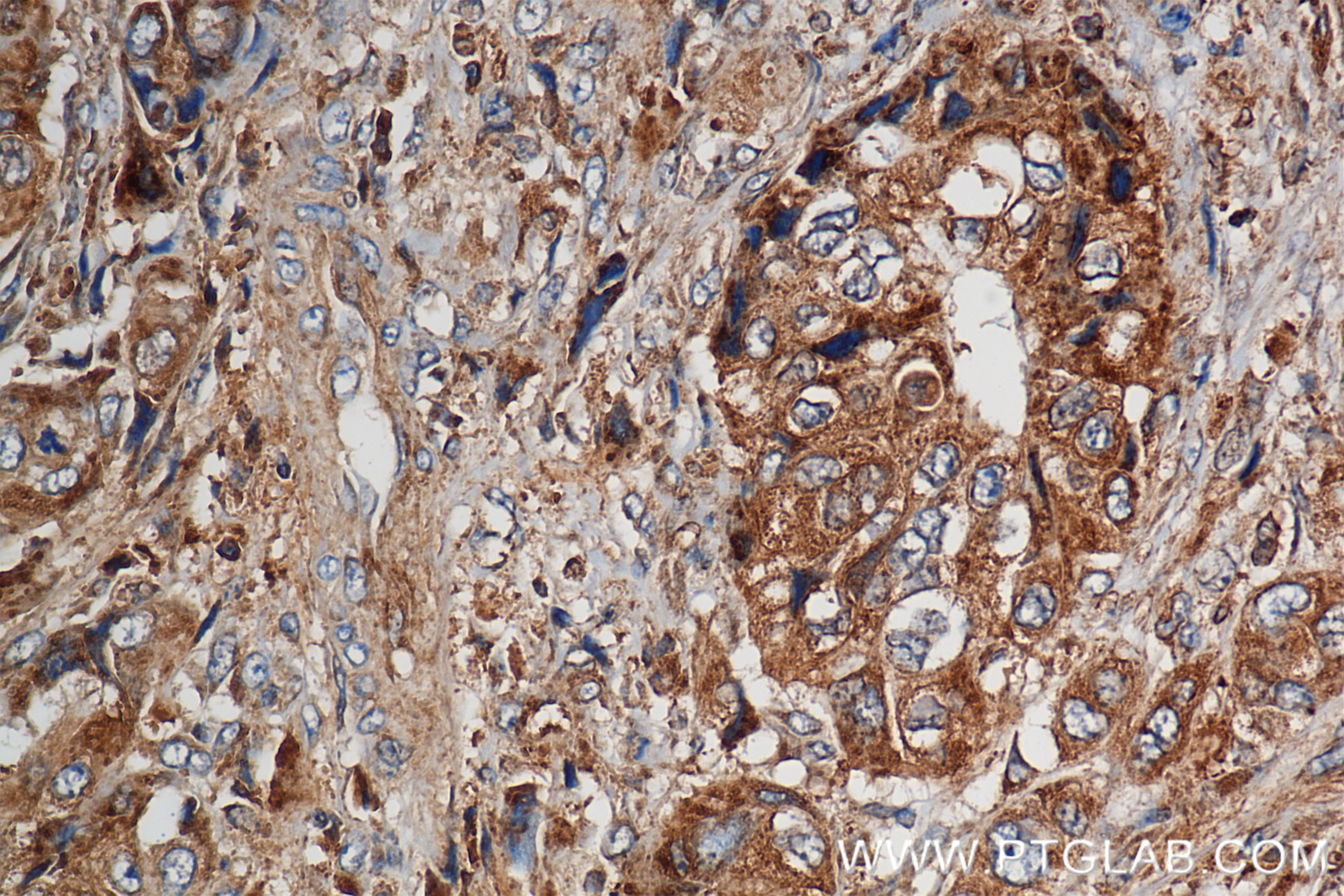 IHC staining of human pancreas cancer using 85766-4-RR