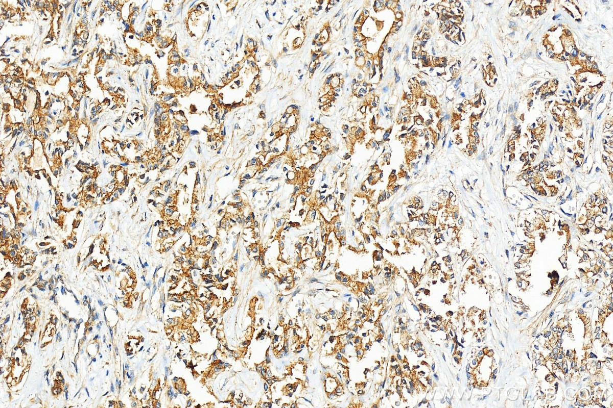 IHC staining of human intrahepatic cholangiocarcinoma using 10161-1-AP