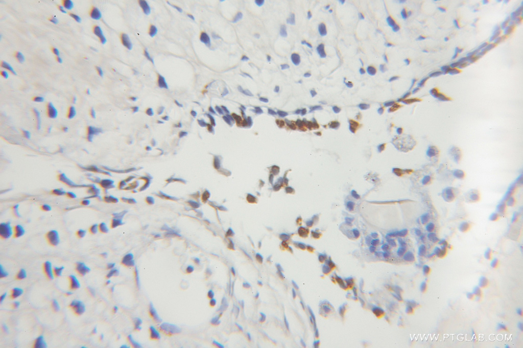 IHC staining of human prostate cancer using 60019-1-Ig