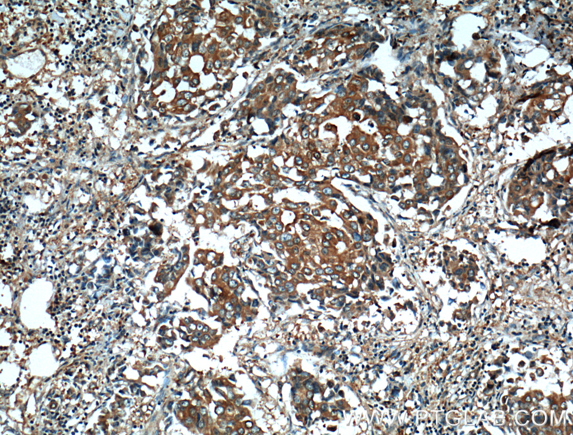 IHC staining of human breast cancer using 14773-1-AP (same clone as 14773-1-PBS)