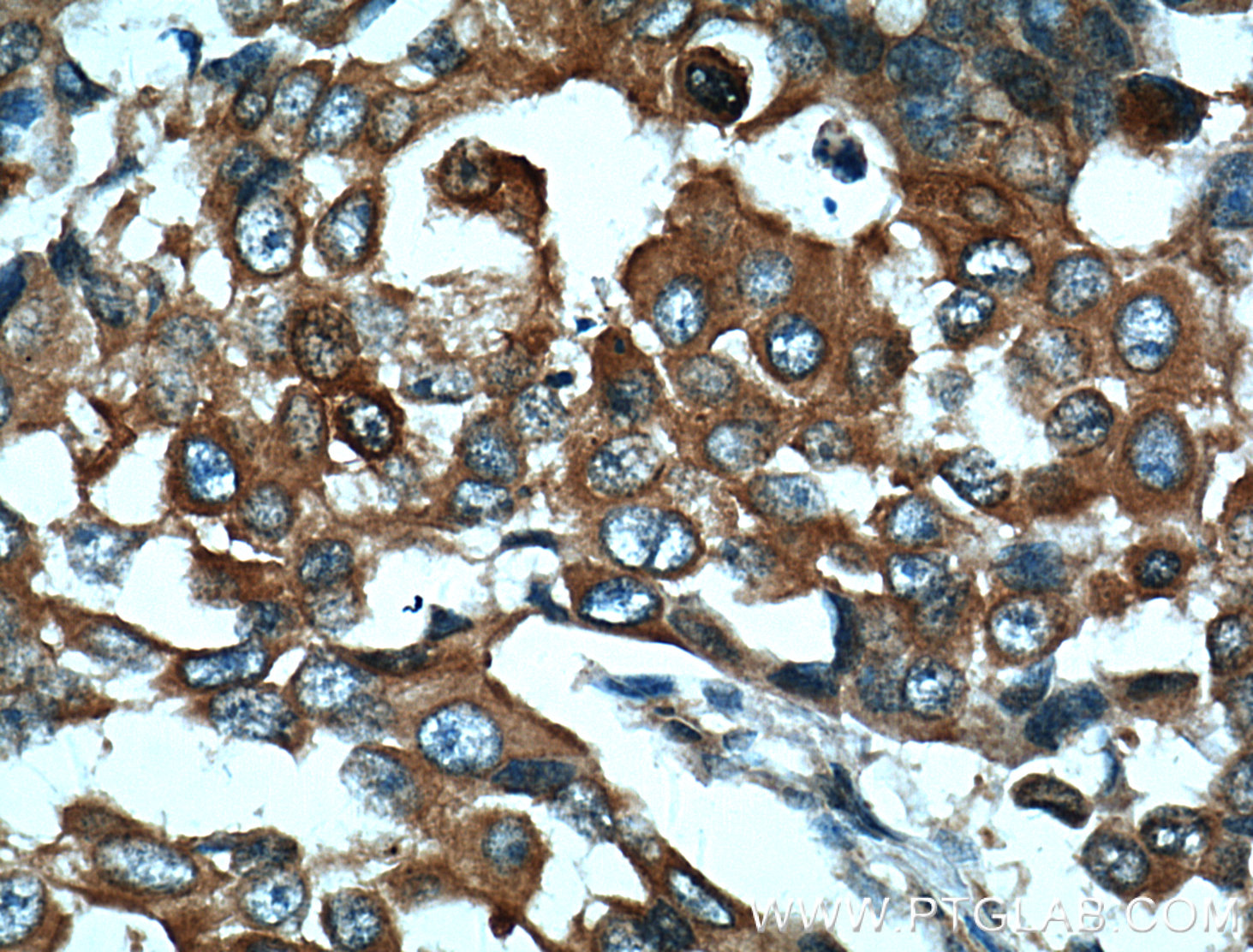 IHC staining of human breast cancer using 14773-1-AP