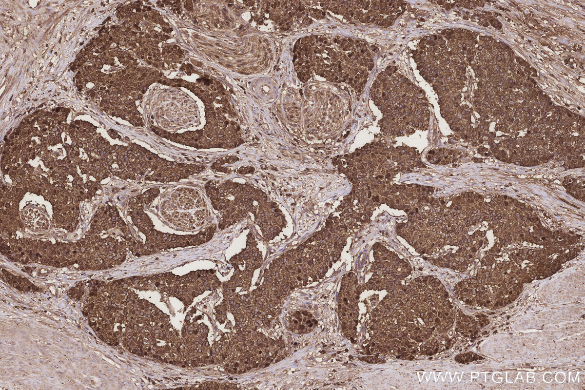 IHC staining of human stomach cancer using 67828-1-Ig IHC staining of human stomach cancer using 67828-1-Ig