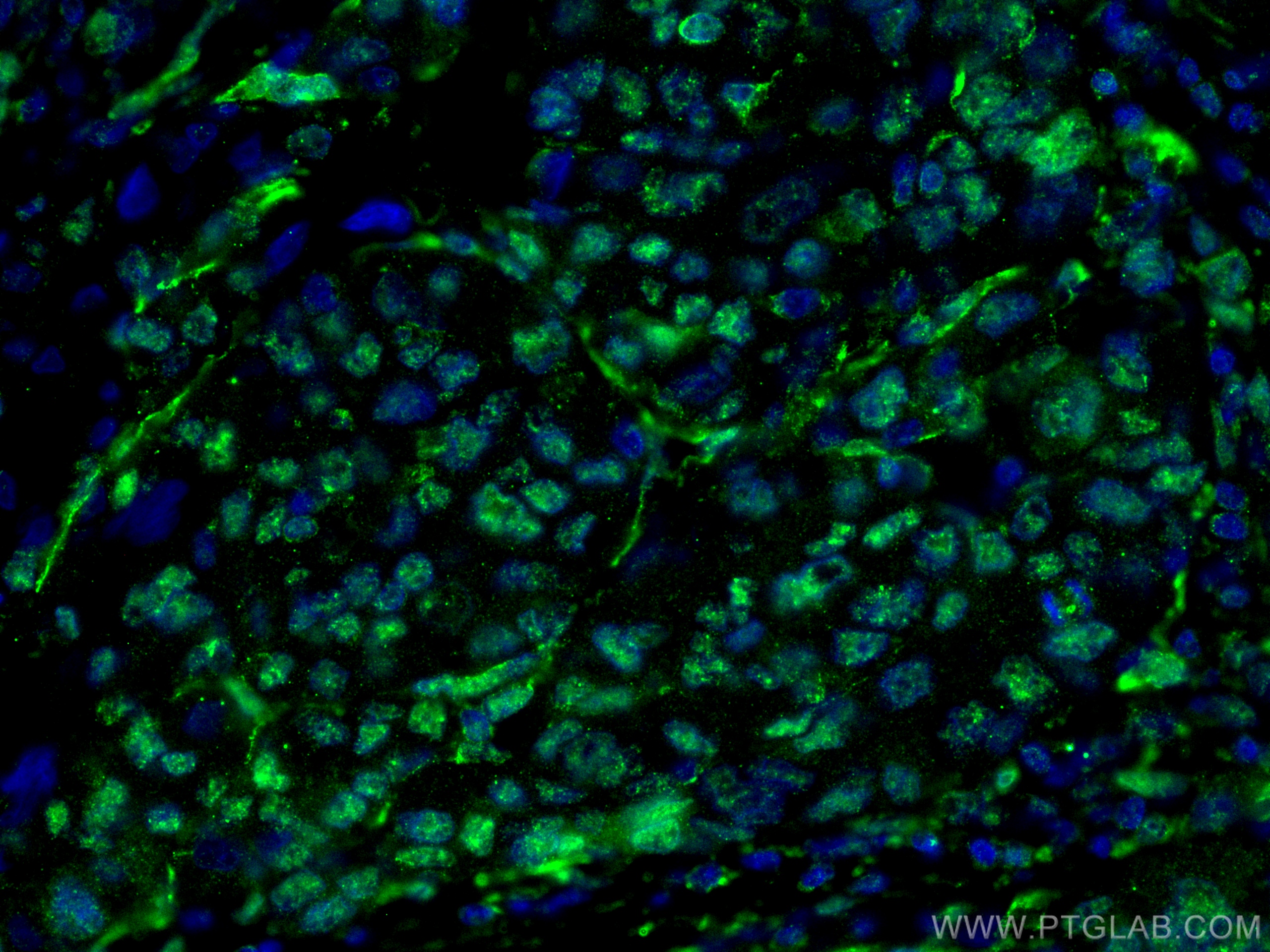 IF Staining of human liver cancer using 66500-1-Ig (same clone as 66500-1-PBS)