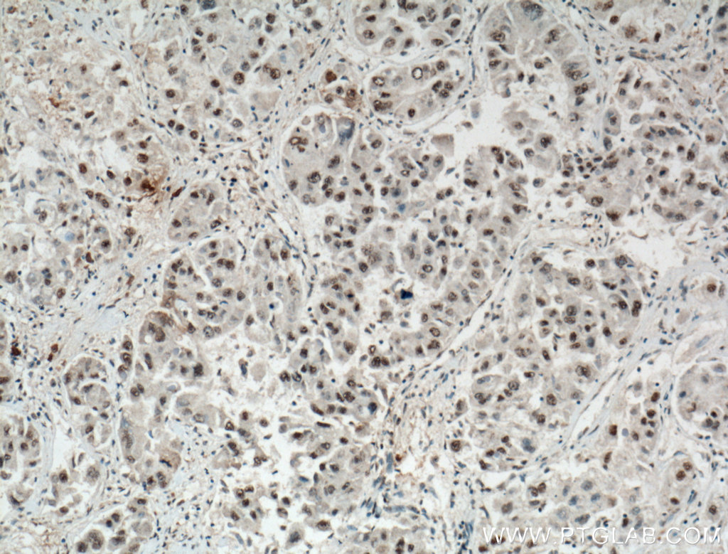 IHC staining of human liver cancer using 66500-1-Ig