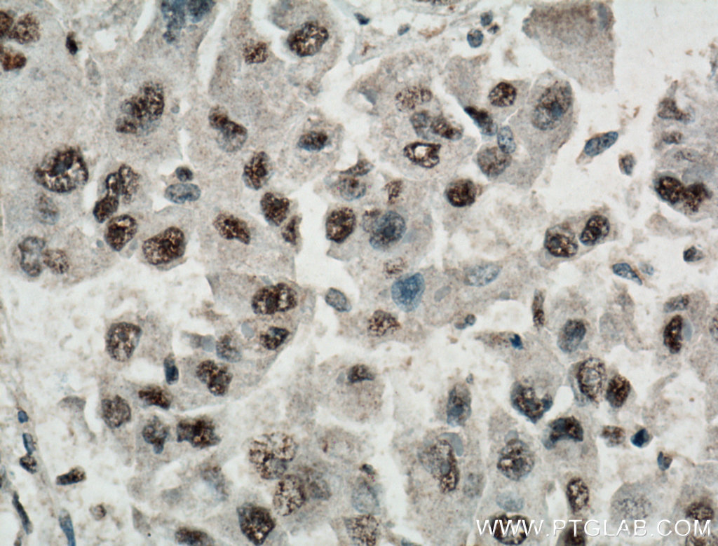 IHC staining of human liver cancer using 66500-1-Ig (same clone as 66500-1-PBS)