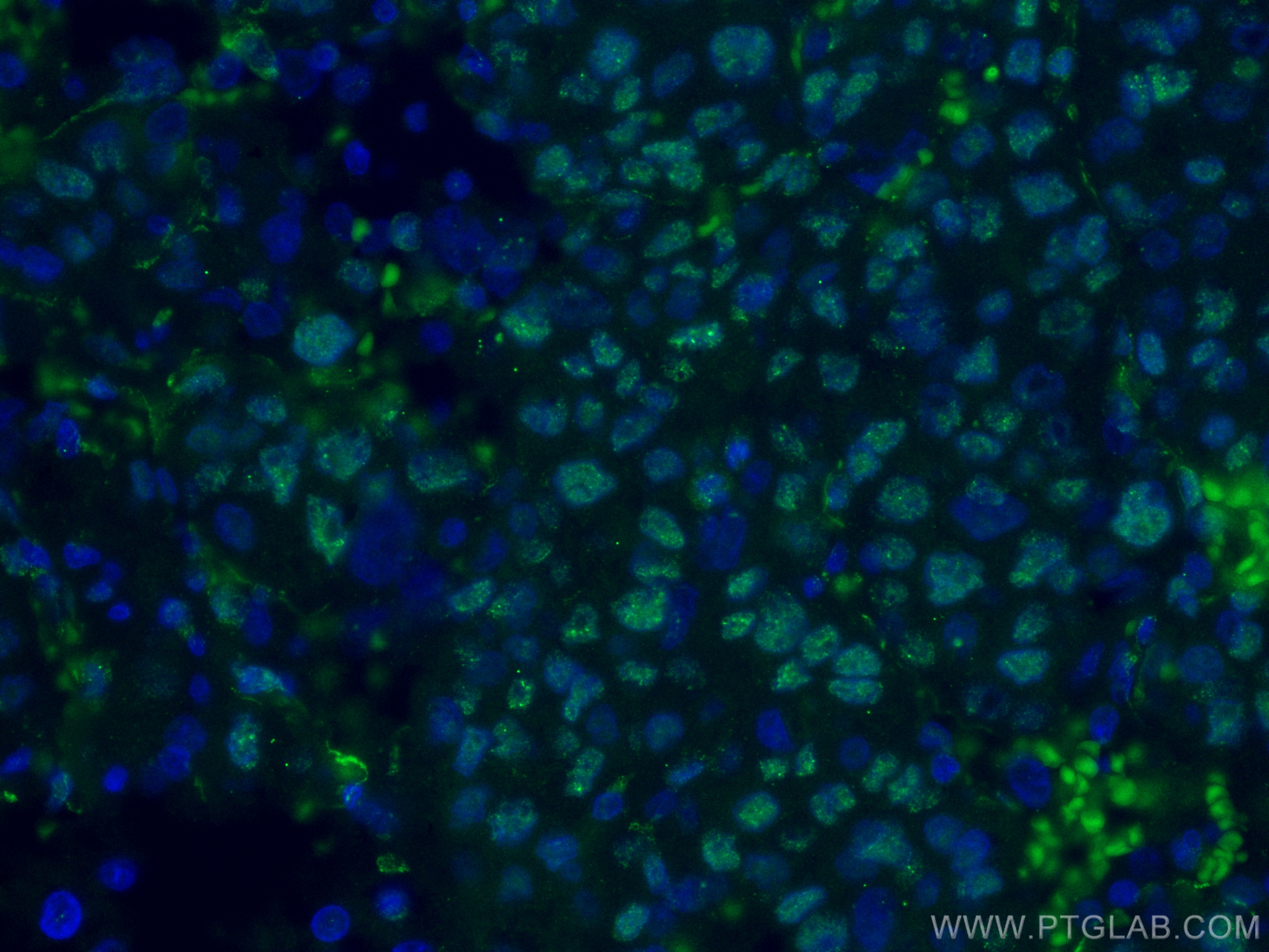 IF Staining of human liver cancer using CL488-66500