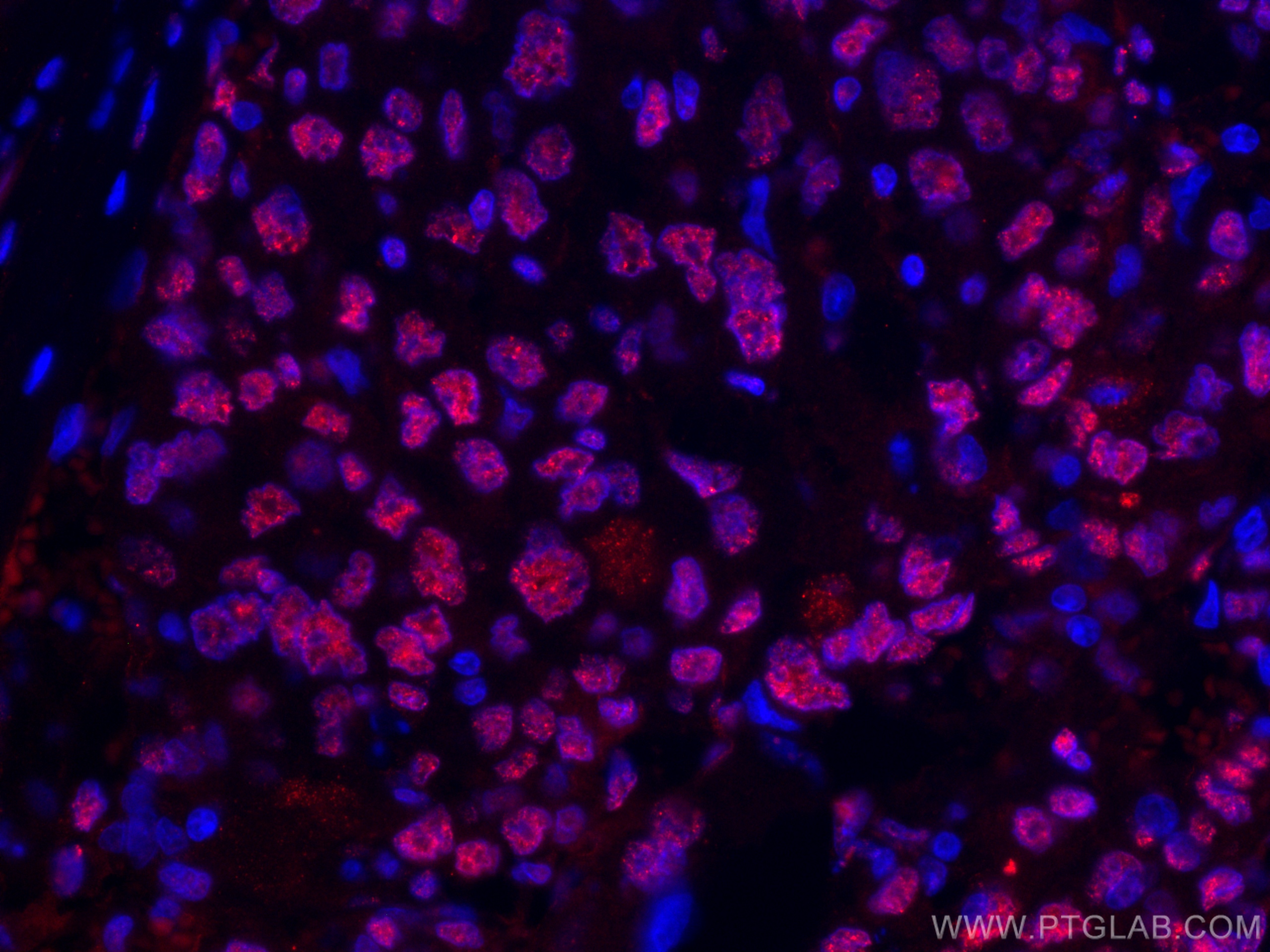 IF Staining of human liver cancer using CL594-66500