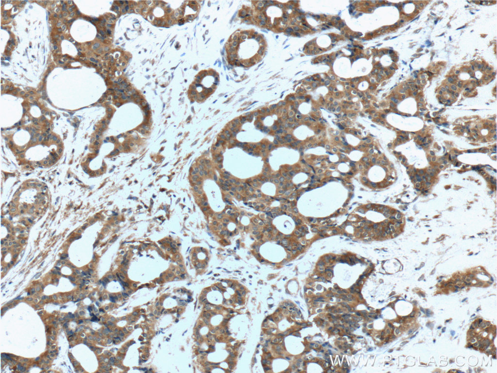 IHC staining of human breast cancer using 20482-1-AP