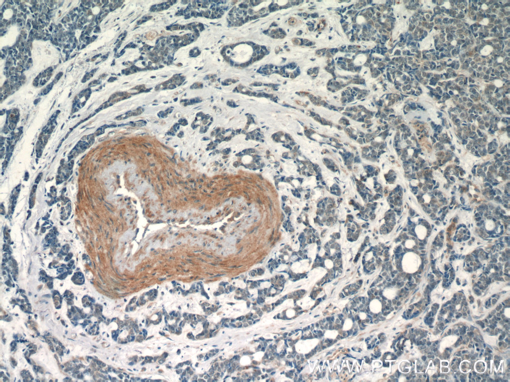 IHC staining of human cervical cancer using 18332-1-AP