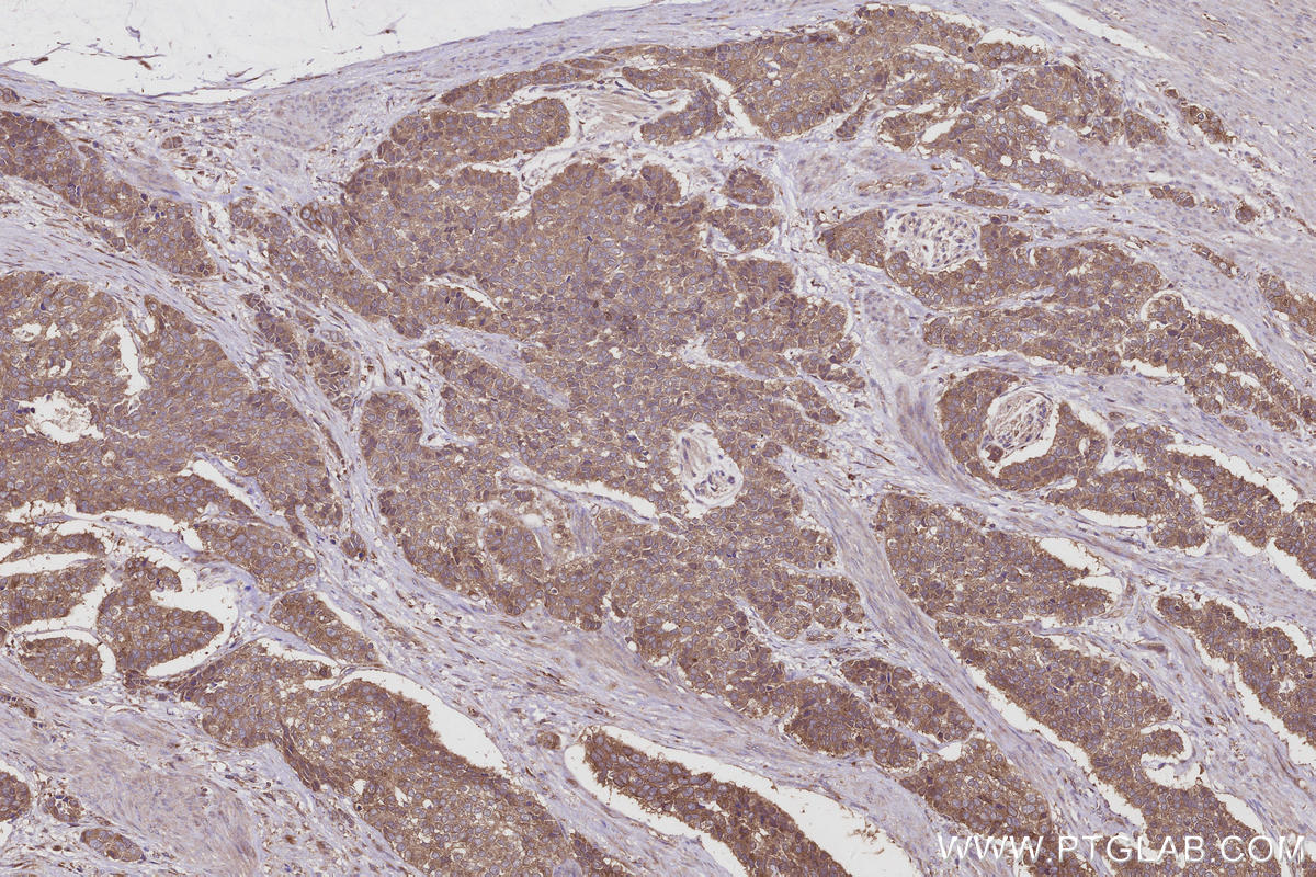Immunohistochemical analysis of paraffin-embedded human stomach cancer tissue slide using 17002-1-AP (TBC1D23 antibody) at dilution of 1:1000 (under 10x lens). Heat mediated antigen retrieval with Tris-EDTA buffer (pH 9.0). IHC staining of human stomach cancer using 17002-1-AP