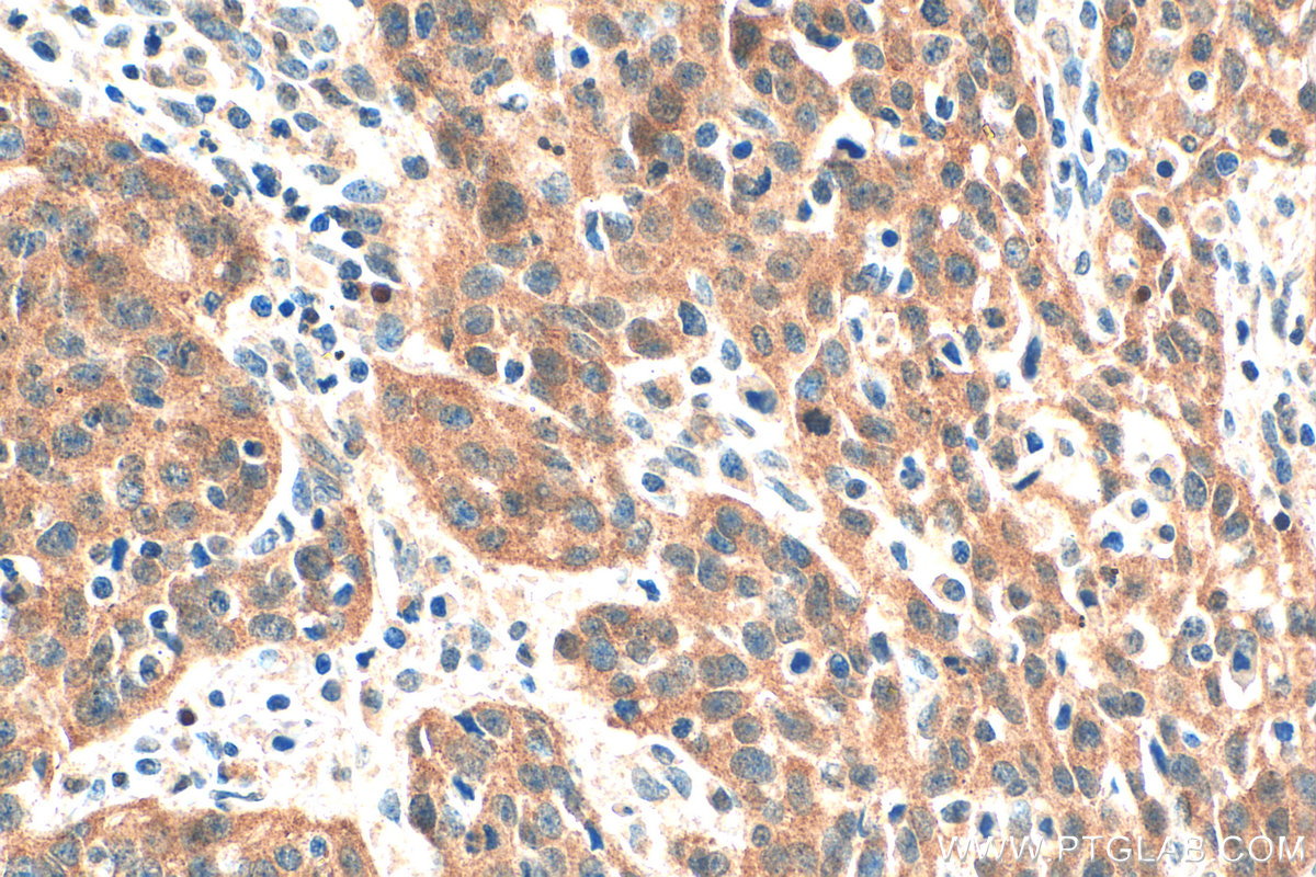 IHC staining of human cervical cancer using 33583-1-AP IHC staining of human cervical cancer using 33583-1-AP