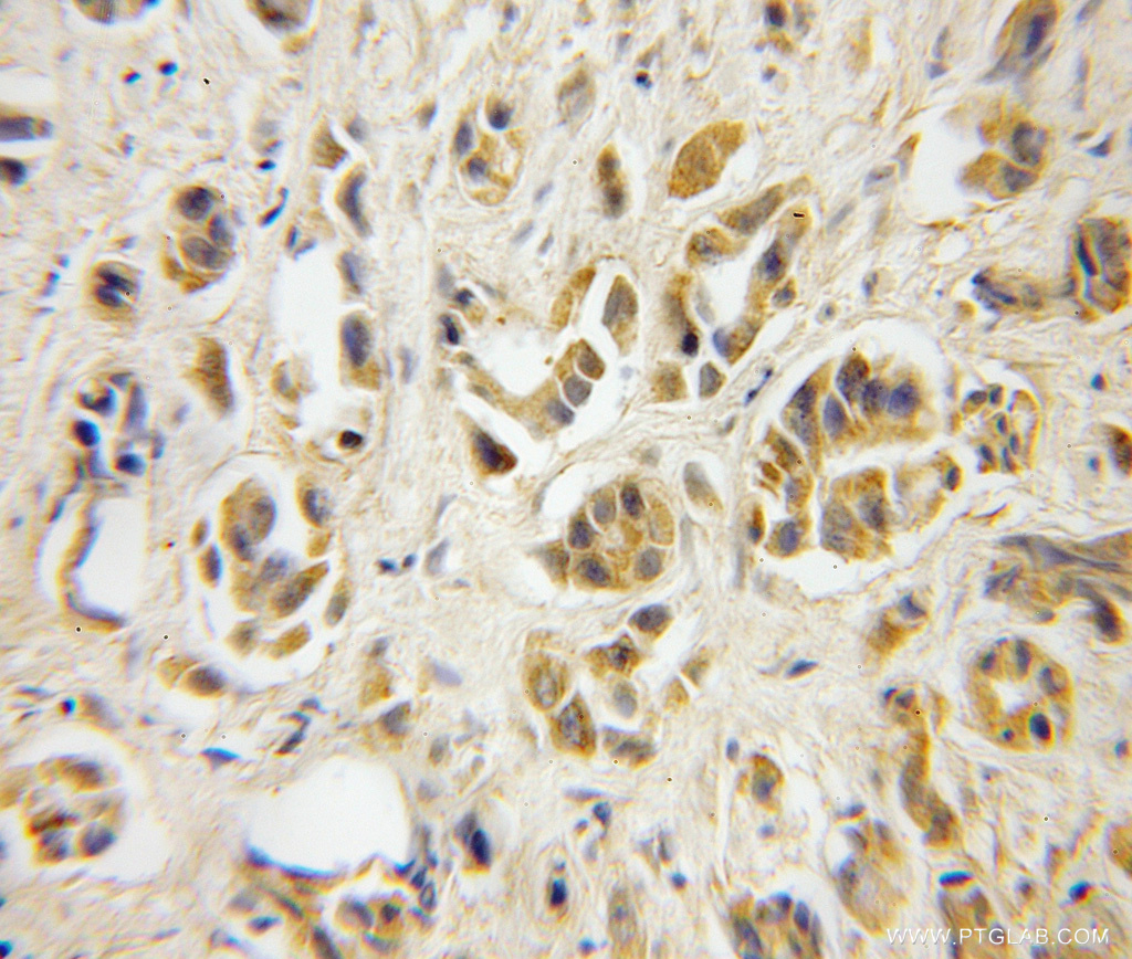 IHC staining of human prostate cancer using 12304-1-AP