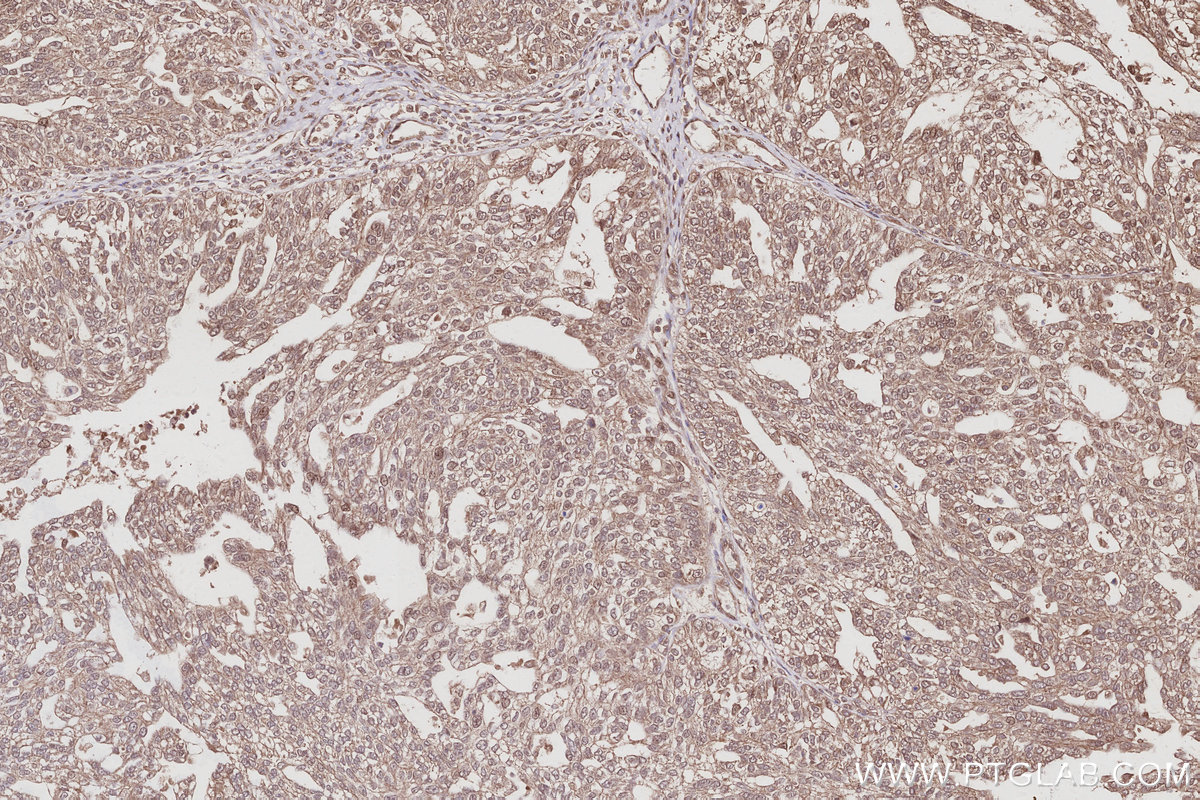 IHC staining of human ovary cancer using 83686-3-RR
