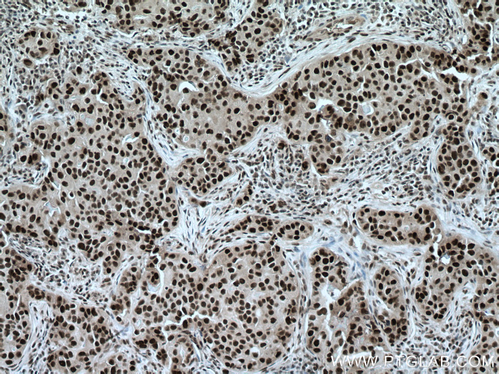 IHC staining of human breast cancer using 66955-1-Ig (same clone as 66955-1-PBS)