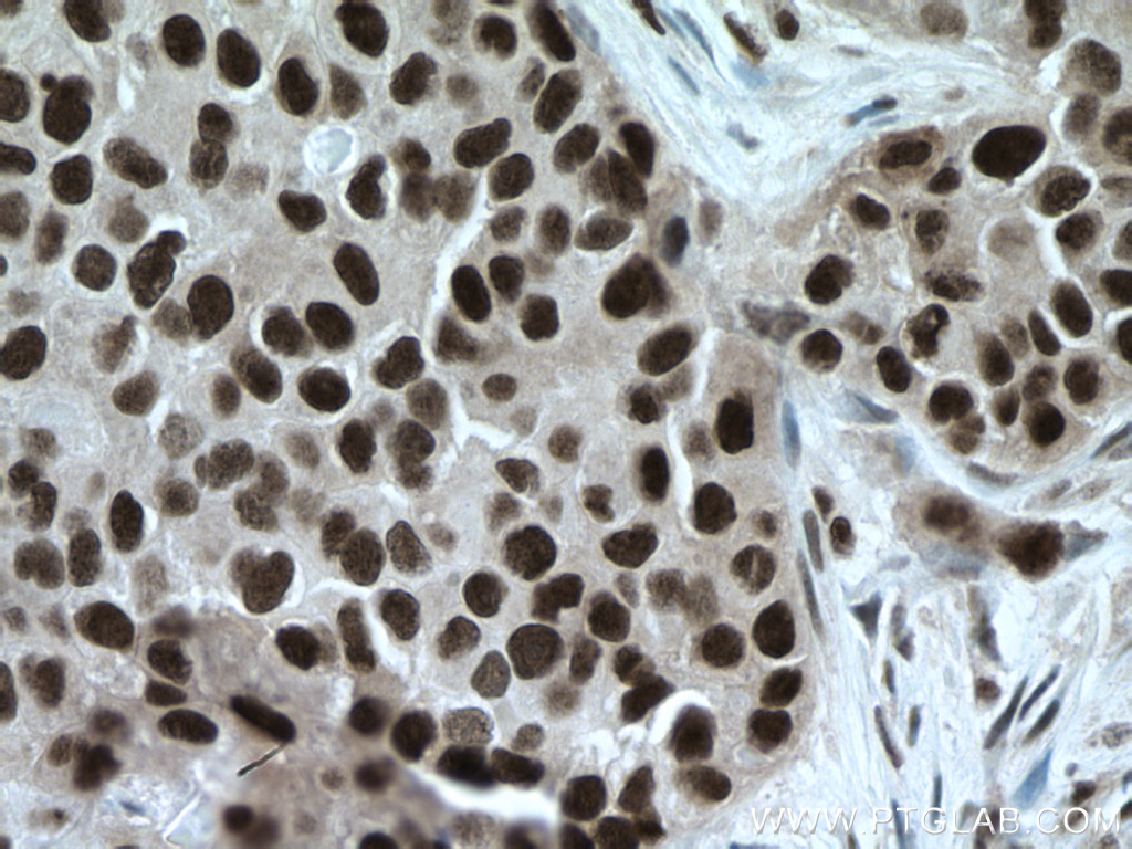IHC staining of human breast cancer using 66955-1-Ig (same clone as 66955-1-PBS)