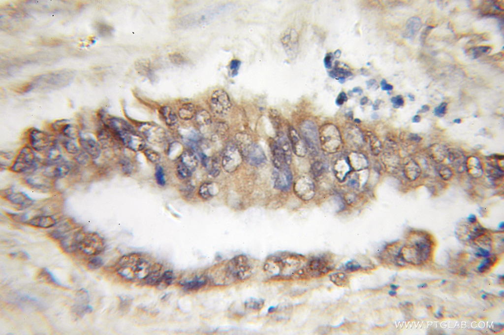 IHC staining of human pancreas cancer using 12488-1-AP (same clone as 12488-1-PBS)