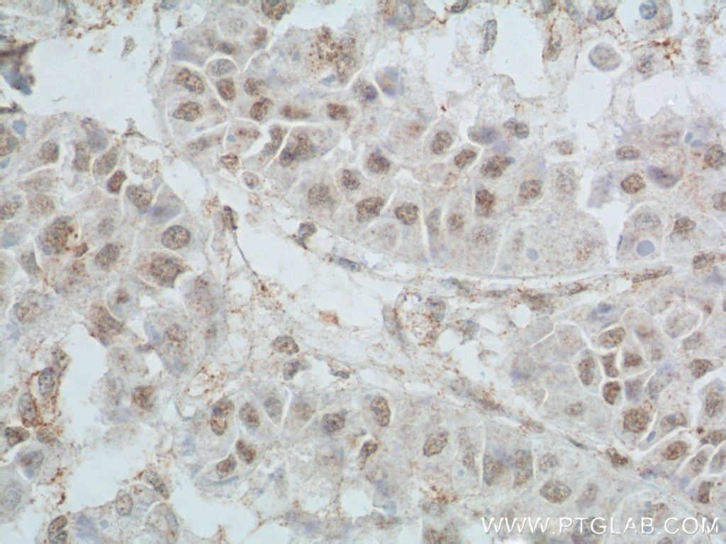 IHC staining of human liver cancer using 66166-1-Ig