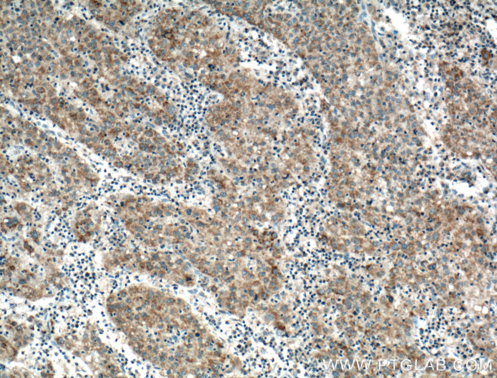 IHC staining of human liver cancer using 16245-1-AP