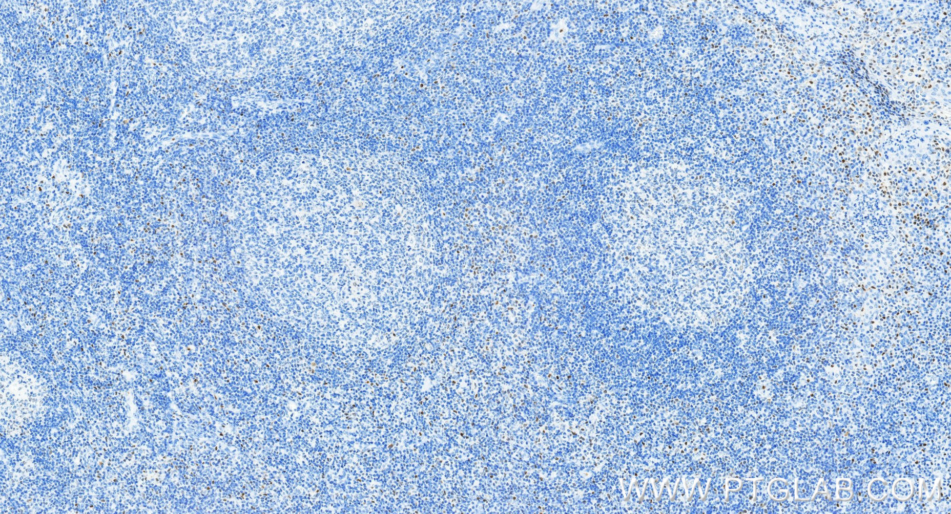 IHC staining of human tonsillitis using 83804-10-RR IHC staining of human tonsillitis using 83804-10-RR