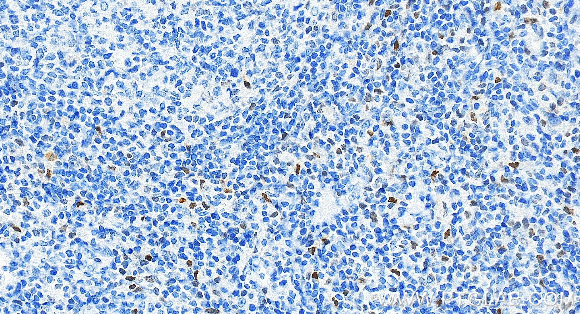 IHC staining of human tonsillitis using 83804-10-RR IHC staining of human tonsillitis using 83804-10-RR