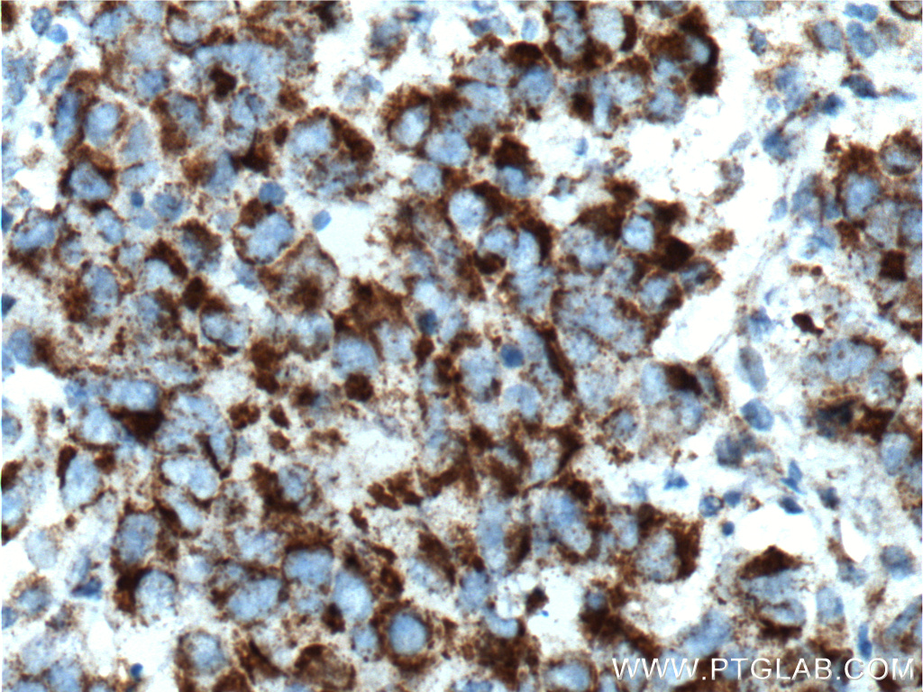 IHC staining of human prostate cancer using 27159-1-AP