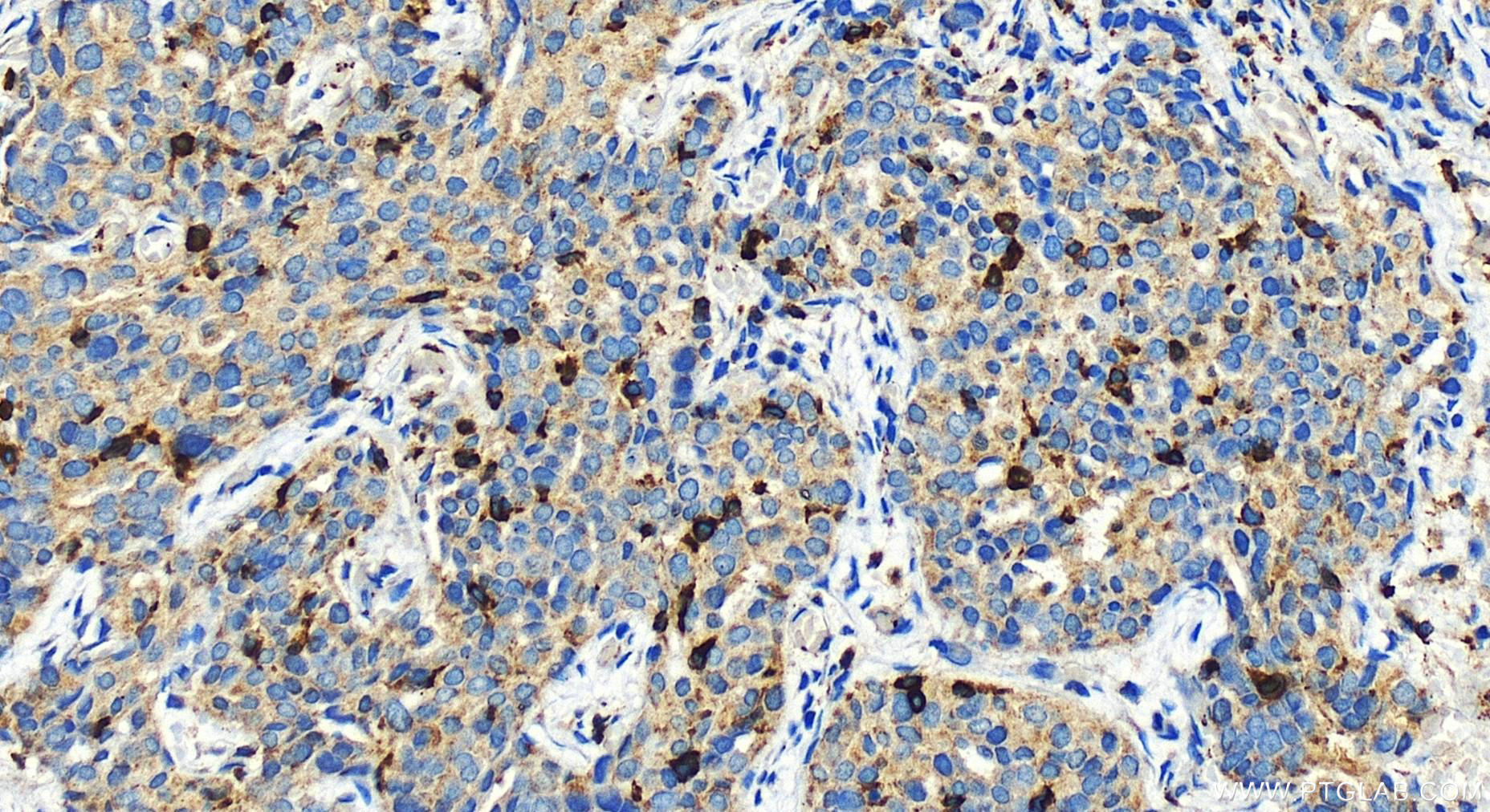 IHC staining of human ovary cancer using 30215-1-AP