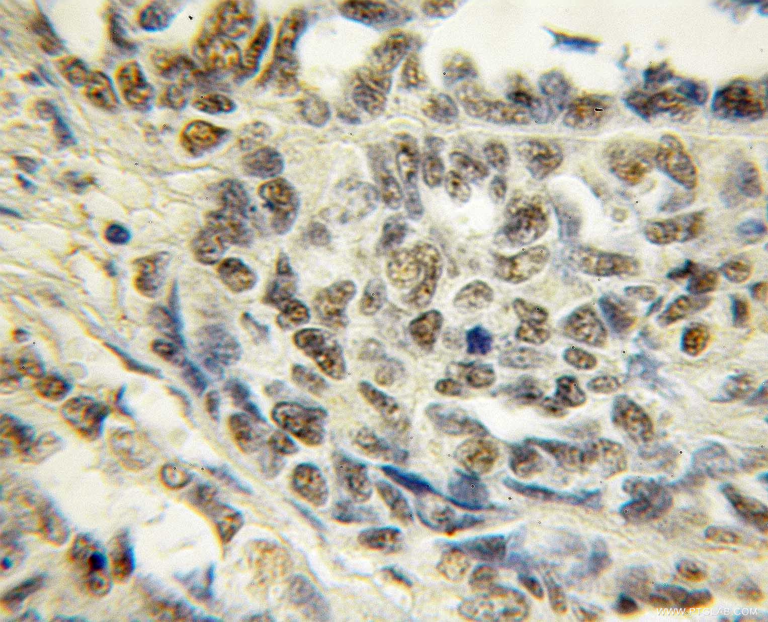 IHC staining of human ovary tumor using 11218-1-AP (same clone as 11218-1-PBS)
