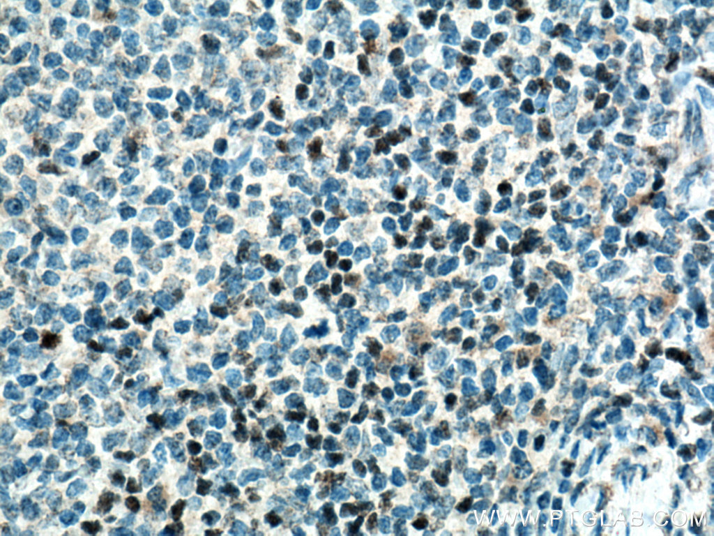 IHC staining of human tonsillitis using 14464-1-AP